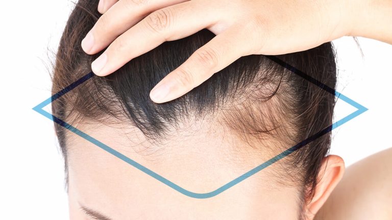 Injerto de cabello para mujer