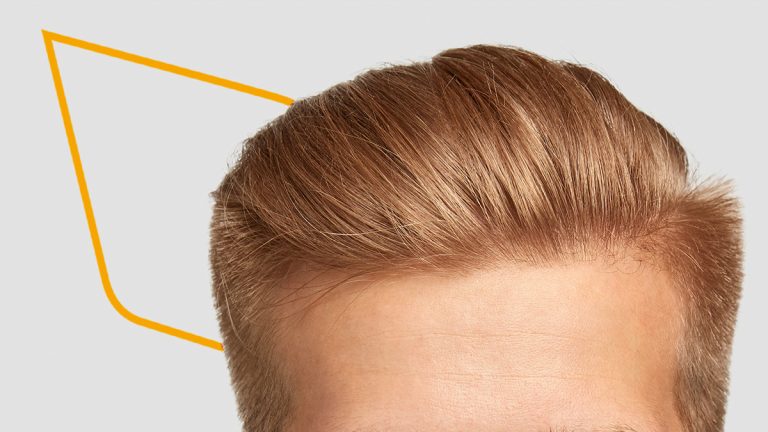 Injerto de cabello sintético, ¿cómo funciona?