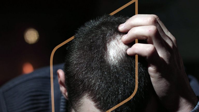 Mesoterapia capilar para alopecia