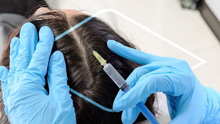 Mesoterapia capilar para alopecia androgenética