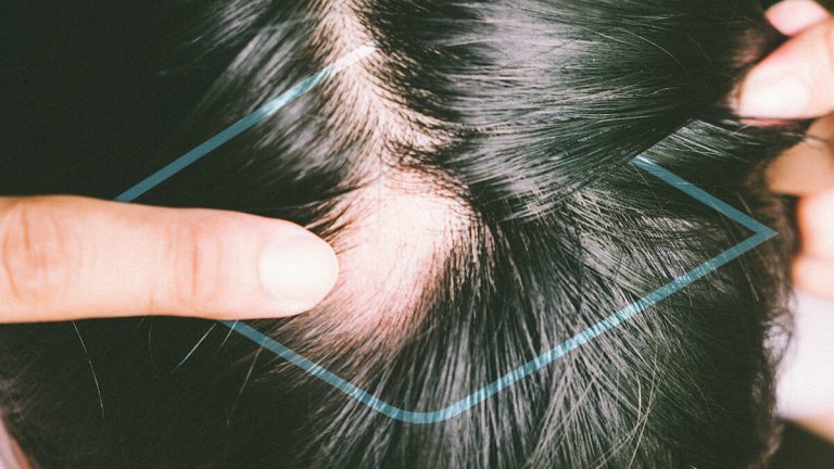 Mesoterapia capilar para alopecia areata