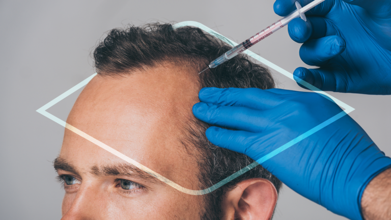 Hombre recibiendo mesoterapia capilar para propiciar el crecimiento del cabello