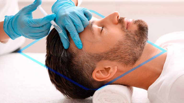 Hombre recibiendo tratamiento de mesoterapia capilar