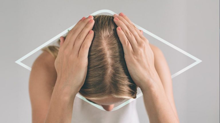 Alopecia androgenética en mujeres