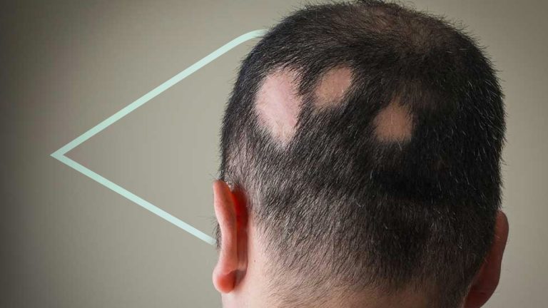 ¿Cuál es el tratamiento para la alopecia areata?