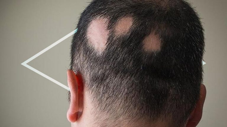 ¿Cuáles son las causas de la alopecia?