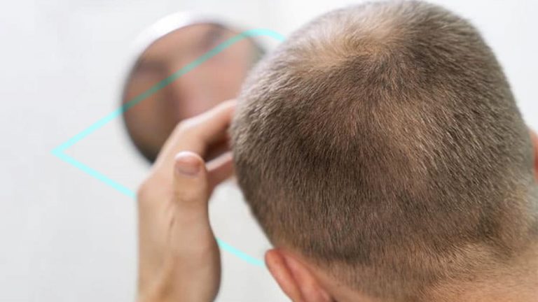 ¿Cómo es la alopecia grado 3?