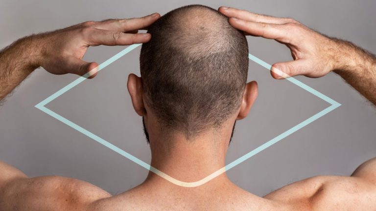 Cuáles son los síntomas de alopecia