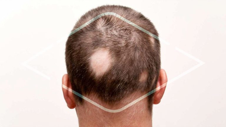 Hombre con alopecia traumática