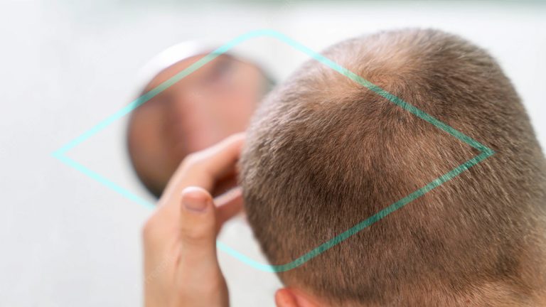 ¿Qué es la alopecia universal?