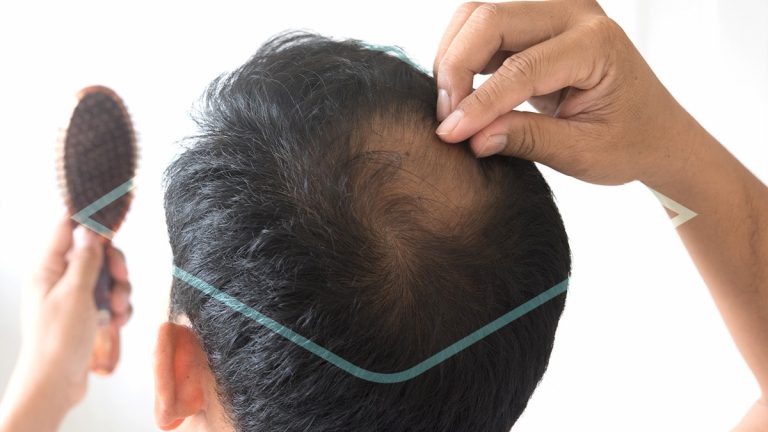 ¿Cuáles son los tratamientos para la alopecia androgenética?