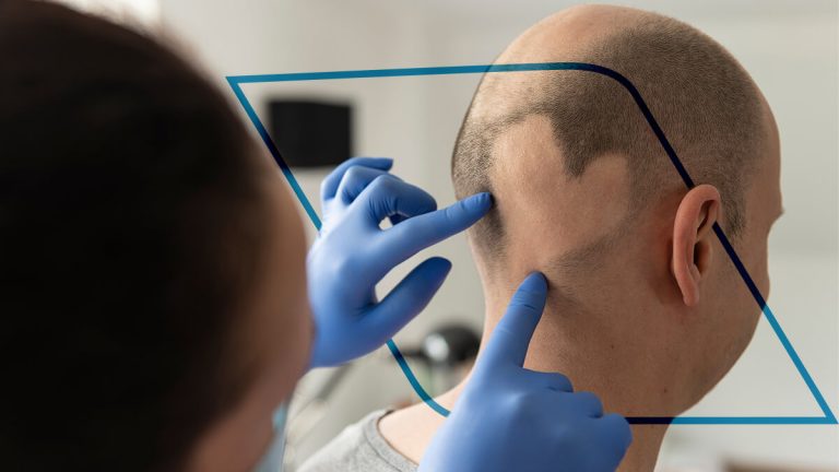 Alopecia areata causas