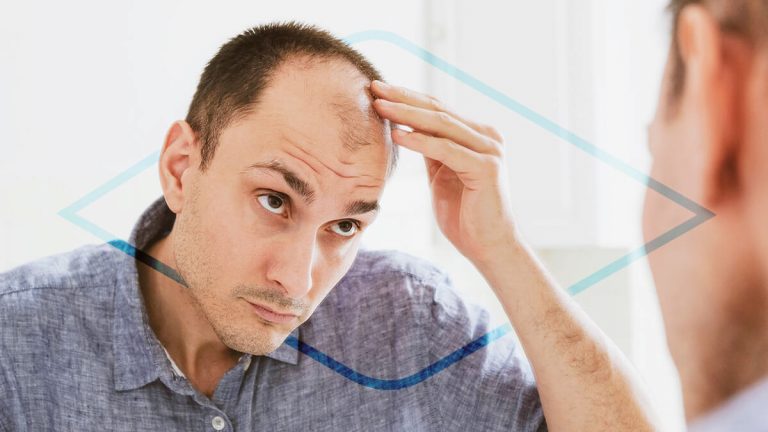 Alopecia en hombres