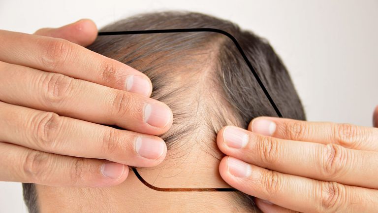 Alopecia no cicatricial