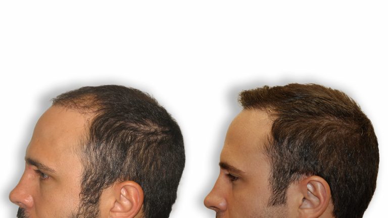 Alopecia, ¿qué significa?