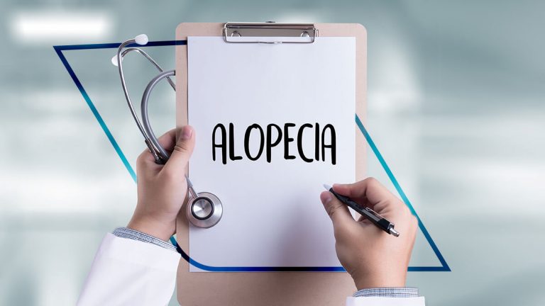 Qué es la alopecia