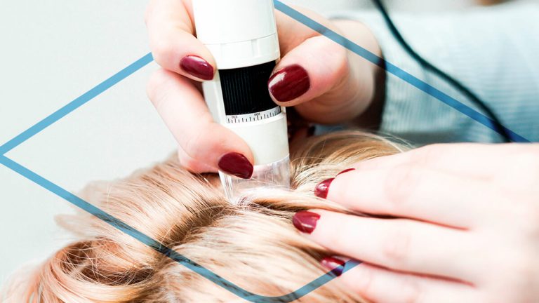 Trasplante de cabello en mujeres Mexico