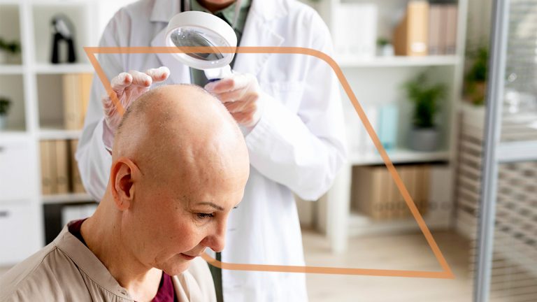 Alopecia en mujeres