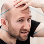 Alopecia qué es