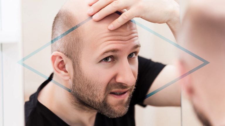 Alopecia qué es