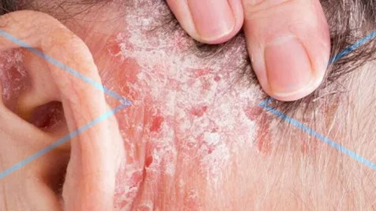 Cuero cabelludo y dermatitis seborreica