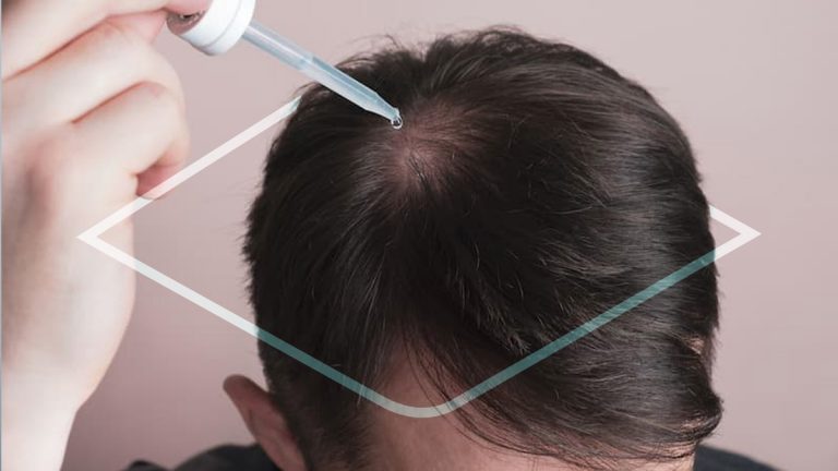 Minoxidil en Farmacias Similares