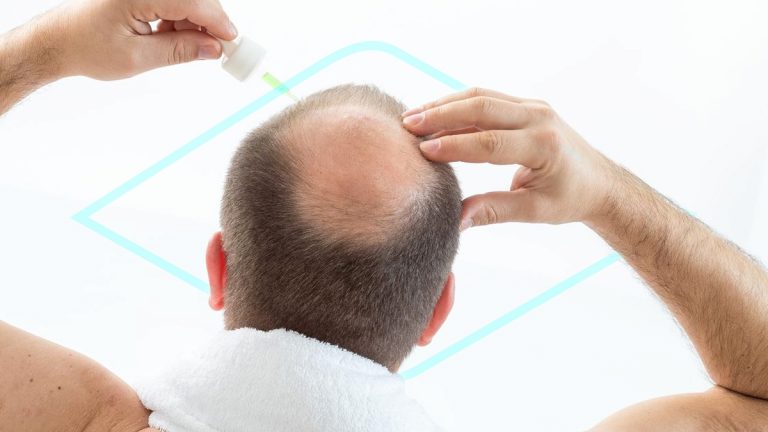 ¿El minoxidil funciona?