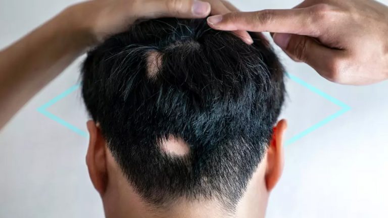 ¿Qué tan efectivo es el minoxidil para la alopecia areata?