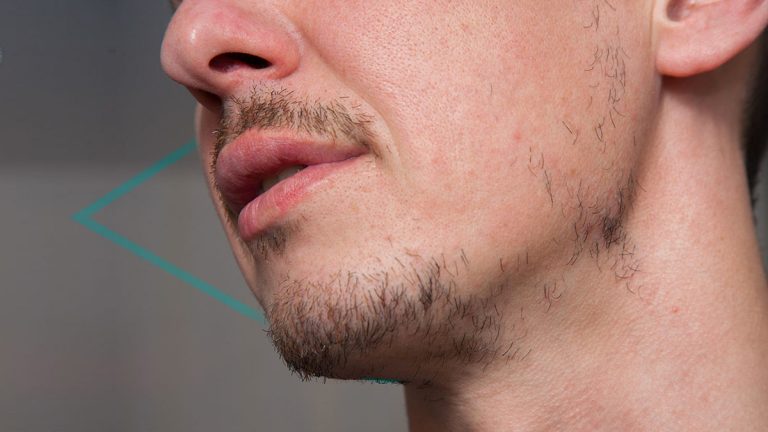 ¿Qué tan bueno es el minoxidil para la barba?