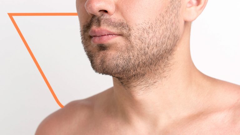 ¿Cuáles son los efectos secundarios del minoxidil en la barba?