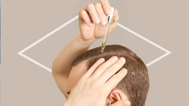 ¿Cómo funciona el minoxidil dérmico?