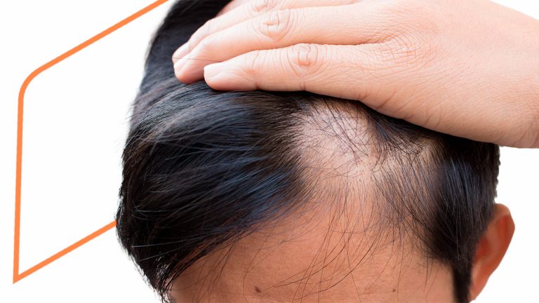 Alopecia en hombres, la información que necesitas saber