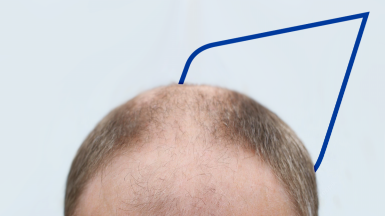 Razones por las que se desarrolla la alopecia masculina