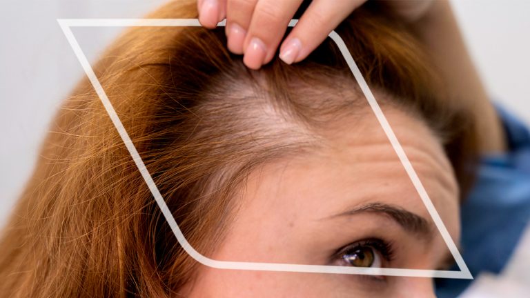 ¿La alopecia hereditaria es irreversible?