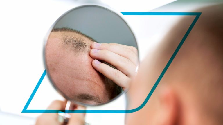 Alopecia por déficit nutricional