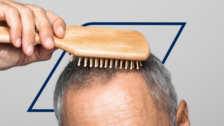 ¿Se puede hacer un trasplante capilar con canas?