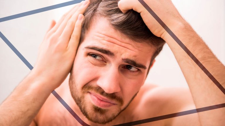 ¿Cuáles son los síntomas de la alopecia areata?